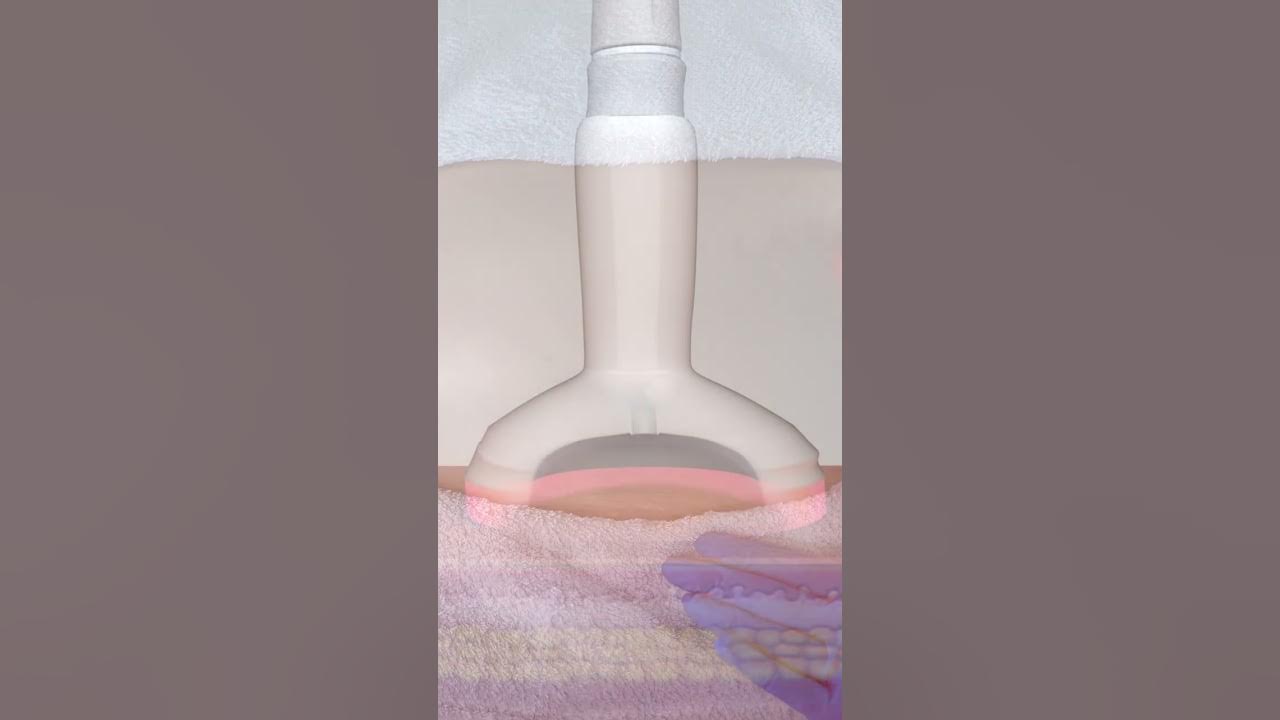 Voorbeeldafbeelding voor de video